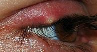 Eyelid Bump: Symptoms, Causes and Treatments