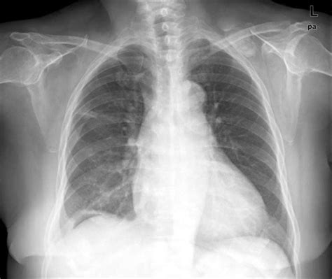 Apical Pleural Thickening