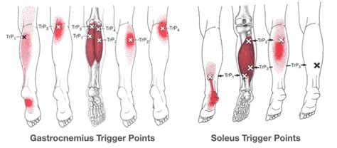 Trigger Points For Plantar Fasciitis How To Find And Release