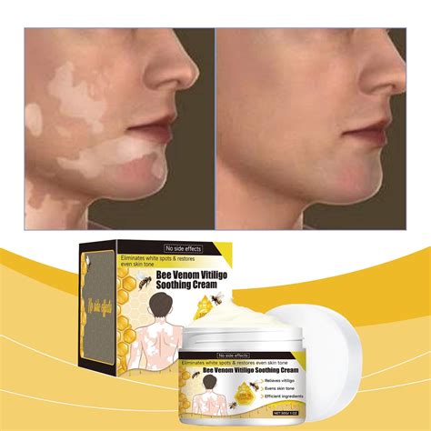 Diandenggg Relieving White Repairing Improving White Skin Discoloration Mens Facial Moisturizer