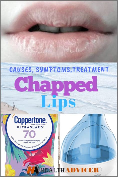 Chapped Lips: Causes, Picture, Symptoms And Treatment