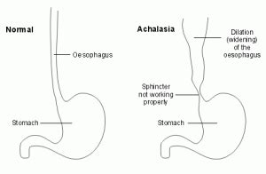 achalasia - DSSurgery