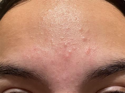 Weird Bumps On Forehead R Skincareaddicts