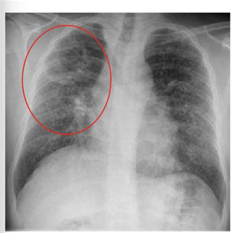 Clin Med: MAC lung Disease Flashcards | Quizlet