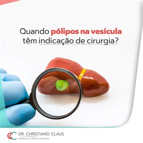 Quando P Lipos Na Ves Cula Tem Indica O De Cirurgia Dr Christiano