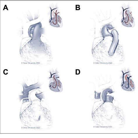 Figure From Biventricular Conversion Of Borderline Hypoplastic Left