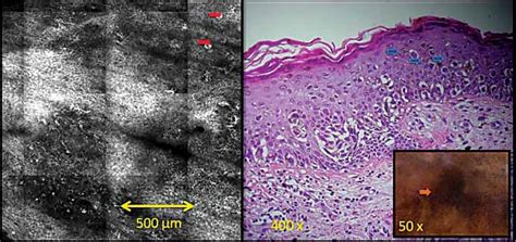 SciELO Brasil Reflectance Confocal Microscopy Of Cutaneous Melanoma