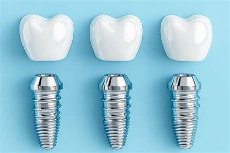 Can Dental Implants Replace Molar Teeth Implants And Root Canals Inc