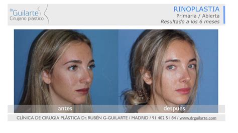 Rinoplastia Madrid Operaci N De Nariz En Madrid Precios Dr Guilarte