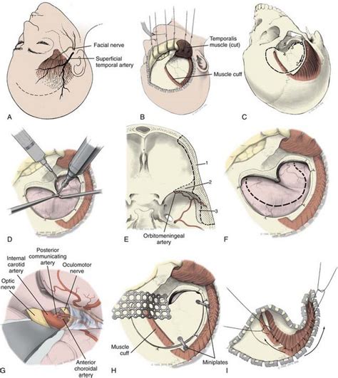 รายการ 97 ภาพ Craniotomy การ พยาบาล อัปเดต