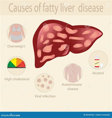 Causes Of Fatty Liver Disease Stock Vector Illustration Of Human