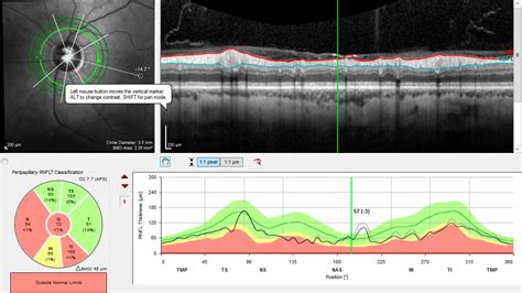 Ocular Coherence Tomography Oct Kindsight Eye Specialists