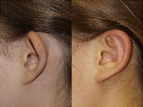 Before After Pictures Otoplasty Ear Pinning Chicago Il Dr Sidle