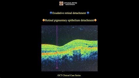 Retinal Detachment Oct