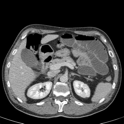 The Radiology Assistant Closed Loop Obstruction In Small Bowel Obstruction