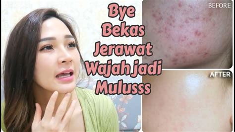 Cara Menghilangkan Bekas Jerawat Dengan Cepat Dan Ampuh Youtube