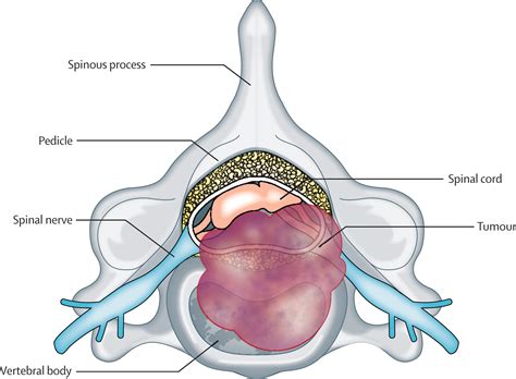 Spinal Cord Compression Spinal Cord Compression Scale