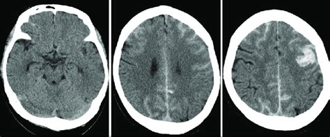 Computed Tomograms On Admission Showing Bilateral Subarachnoid