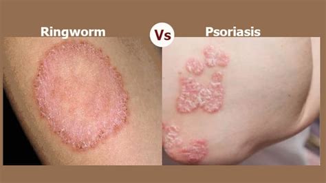 Difference Between Ringworm Vs Psoriasis