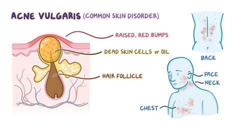 Acne Vulgaris