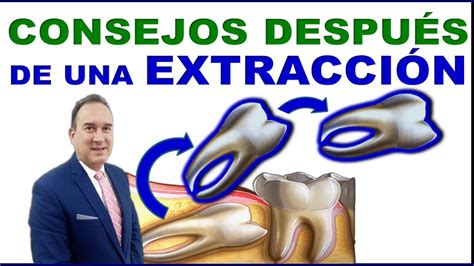 ExtracciÓn Dental Cuidados DespuÉs De Una CirugÍa Youtube