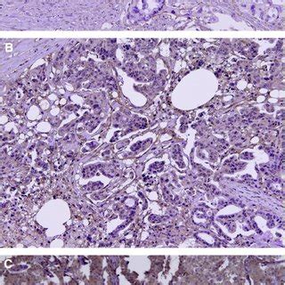 Immunohistochemical Staining Of Human Pancreatic Cancer Tissue For