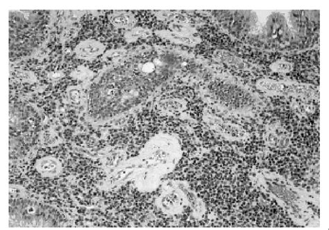 Stroma Contains Mixed Chronic Inflammatory Cell Infiltrate Nb