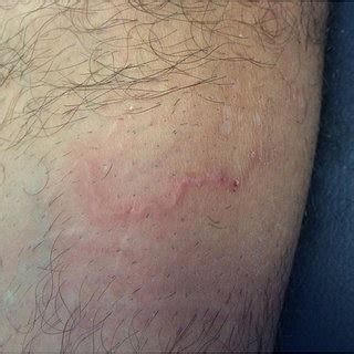 CLM. Eroded, linear serpiginous or serpentine papules with haematic ...