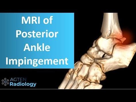 MRI of posterior ankle impingement : Radiology