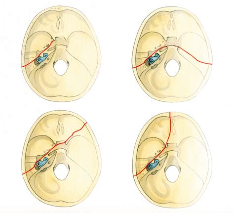 Fractures of the Cranial Base – Skull Base Surgery Atlas