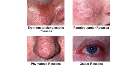 Treatments for Rosacea Orlando | Associates In Dermatology