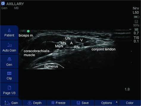 Ultrasound-guided axillary brachial plexus block | Anesthesia Key