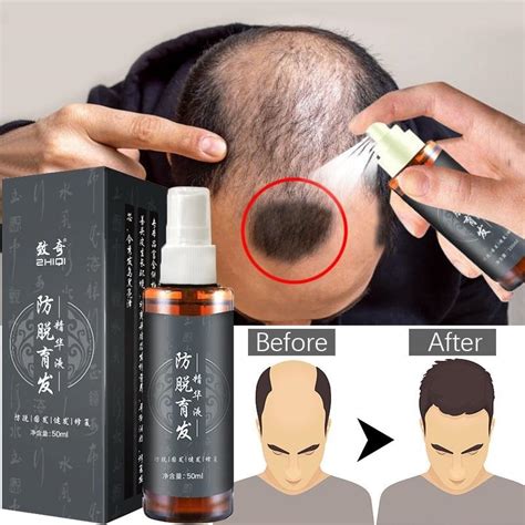 Jual Serum Penumbuh Rambut Anti Botak Penumbuh Rambut Botak Penyubur