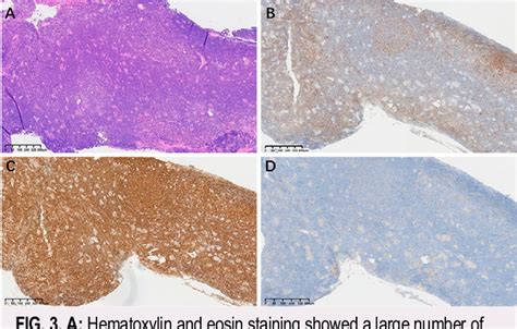 Figure 3 From Chronic Lymphocytic Leukemia Small Lymphocytic Lymphoma