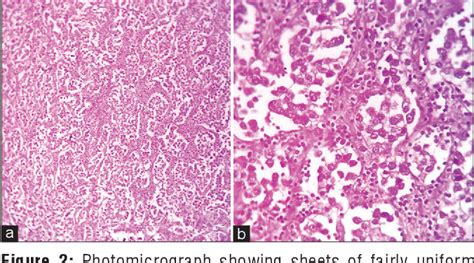 Figure 1 From Swyer Syndrome 46xy Pure Gonadal Dysgenesis Presenting