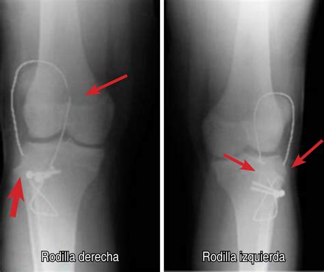 Bilateral Avulsion Fractures Of The Tibial Tuberosity In An Adolescent