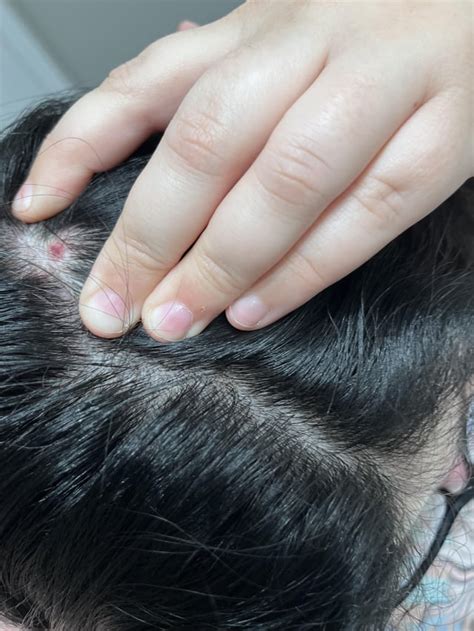 Another Update On My Scalp Cyst R Popping