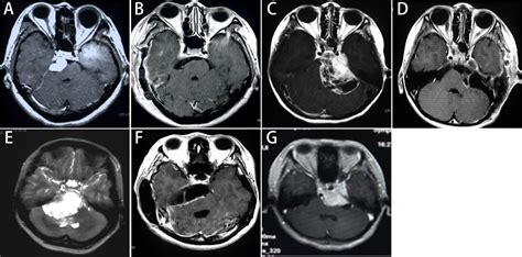 Frontiers Surgical Treatment And Clinical Outcomes Of Petroclival