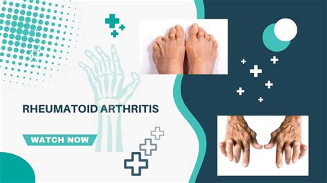 Rheumatoid Arthritis 101 Causes Symptoms And Treatment Options