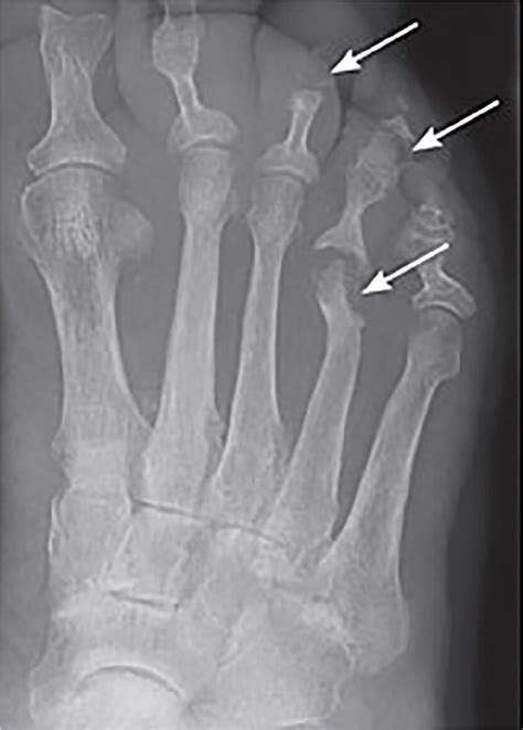 Osteomyelitis X Ray Features