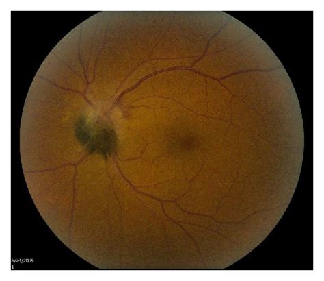 Case 1 Fundus Photograph Of Optic Disk Melanocytoma Download Scientific Diagram