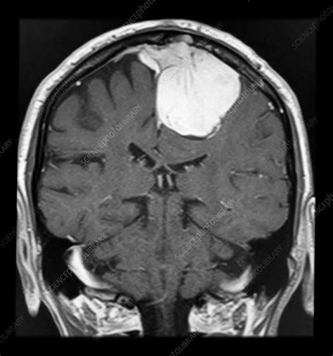 Parafalcine Meningioma MRI - Stock Image - C043/0278 - Science Photo Library