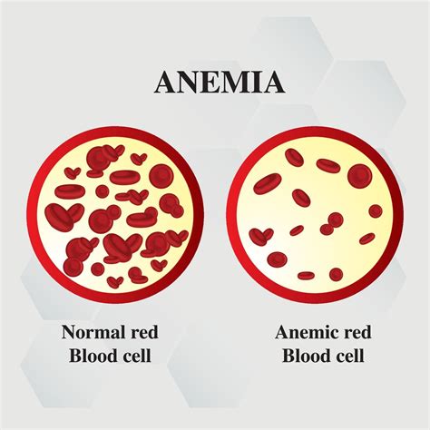 Anemia amount of red blood Iron deficiency anemia difference of Anemia ...