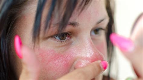 Analyste Réunion radical plaque rouge qui brule sur le visage Mount