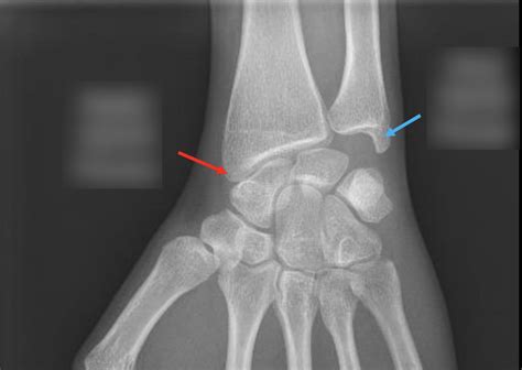 Handwrist Bony Anatomy Radiology Diagram Quizlet