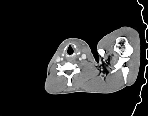 Severe Ludwig Angina Image