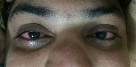 Moderate lid edema, conjunctival congestion with mild chemosis and ...