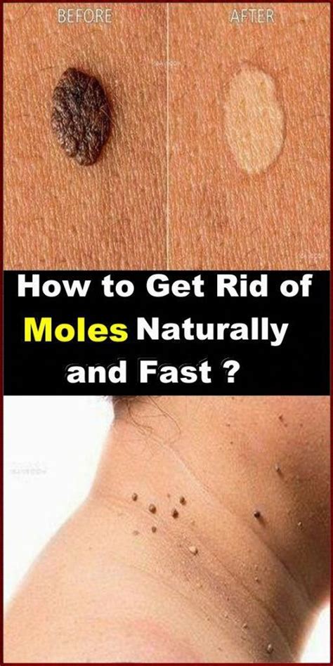 How To Get Rid Of Moles Fast And Naturally Skin Name