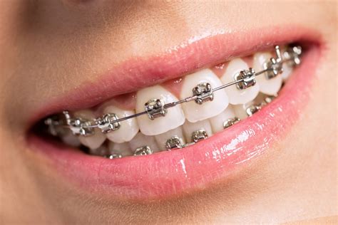 Invisalign Alinhador Transparente Clarus Odontologia