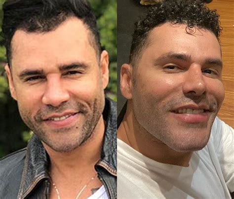 Antes de depois dos famosos que fizeram harmonização facial